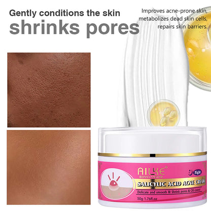 Organic Acne Face Cream