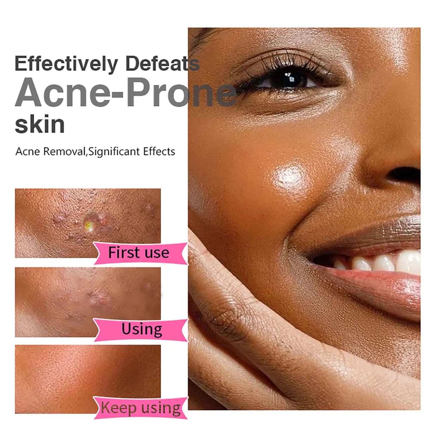 Organic Acne Face Cream